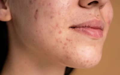 How Do I Treat Hyperpigmentation?