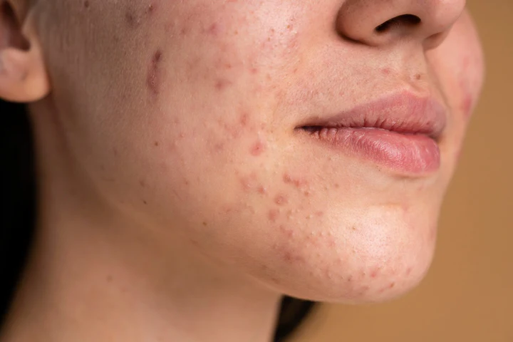 How Do I Treat Hyperpigmentation?