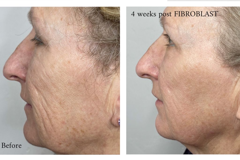 Fibroblast Skin Tightening: A Non-Surgical Treatment for Sagging Skin